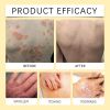 OCEAURA Herbal Psoriasis Care Soap, Soothing And Moisturizing Skin Refreshing Soap